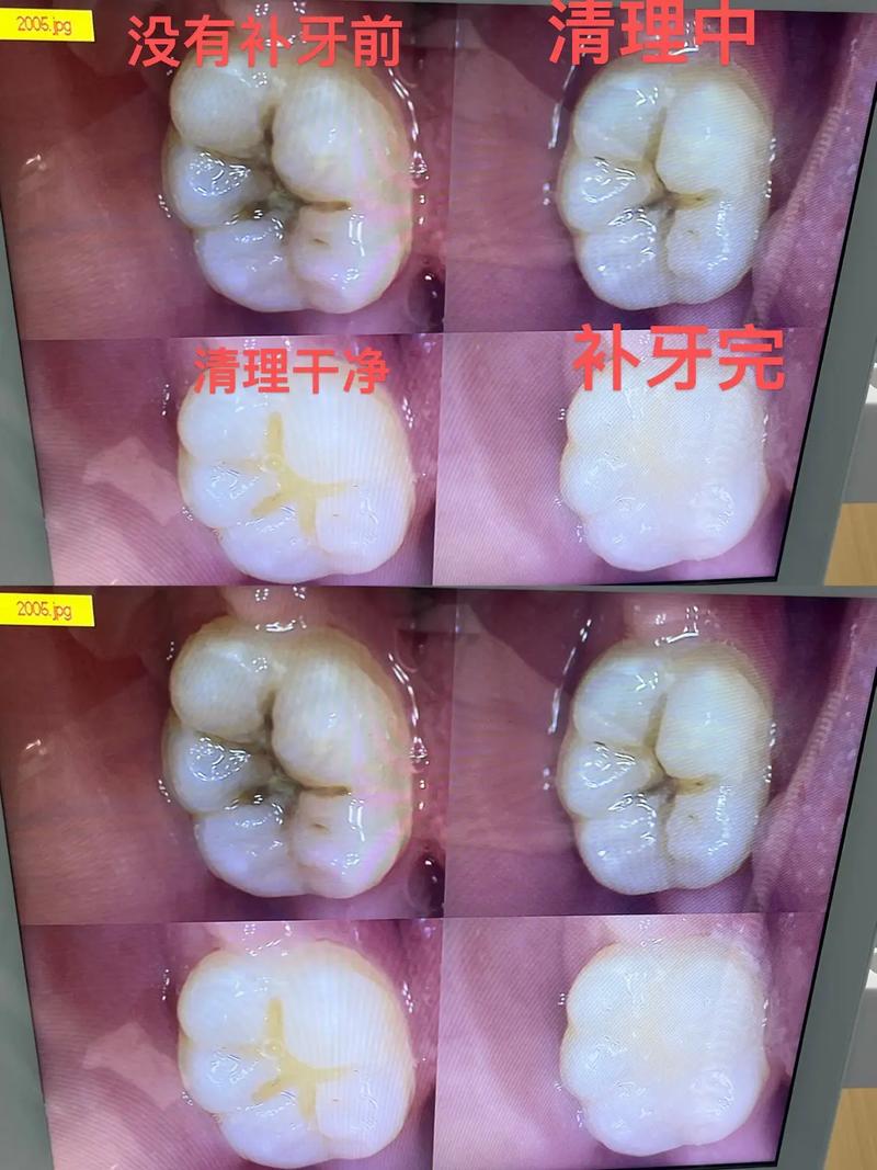 今日科普一下！补牙钻头掉进嘴巴里,百科词条爱好_2024最新更新